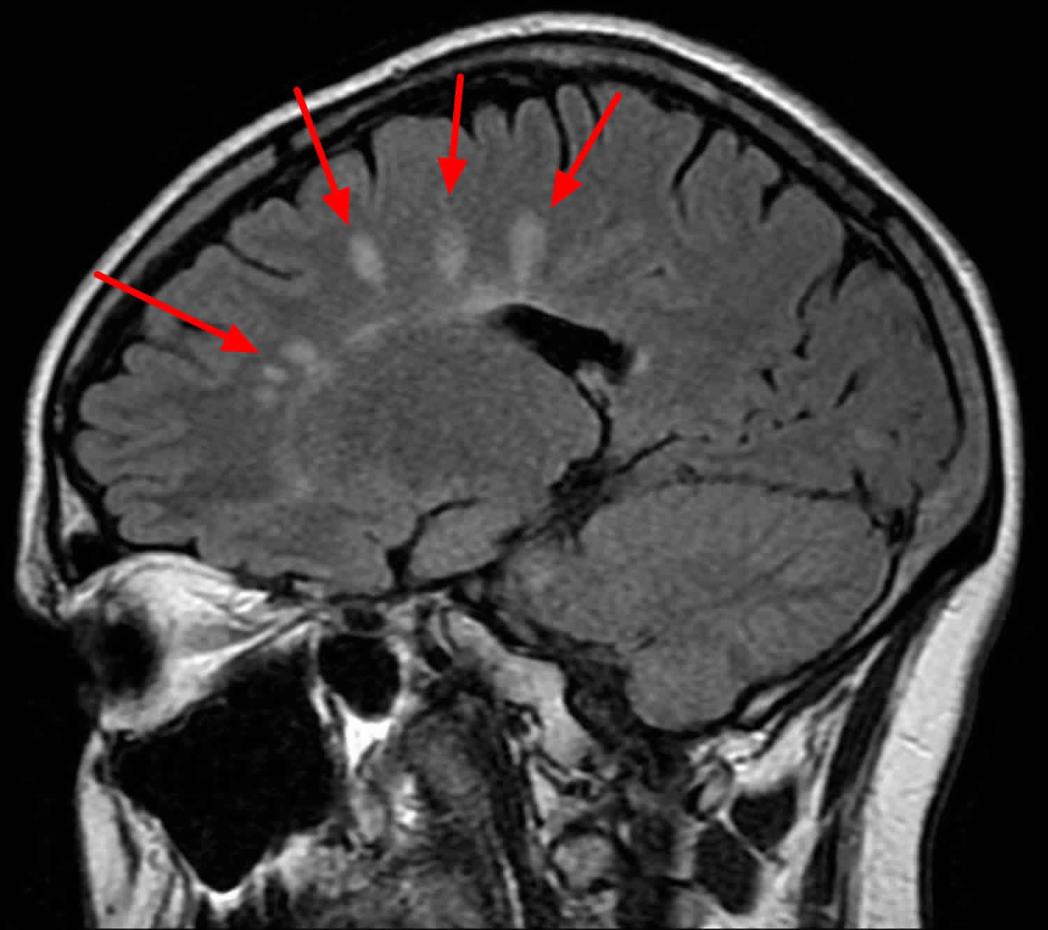 MS brain lesions