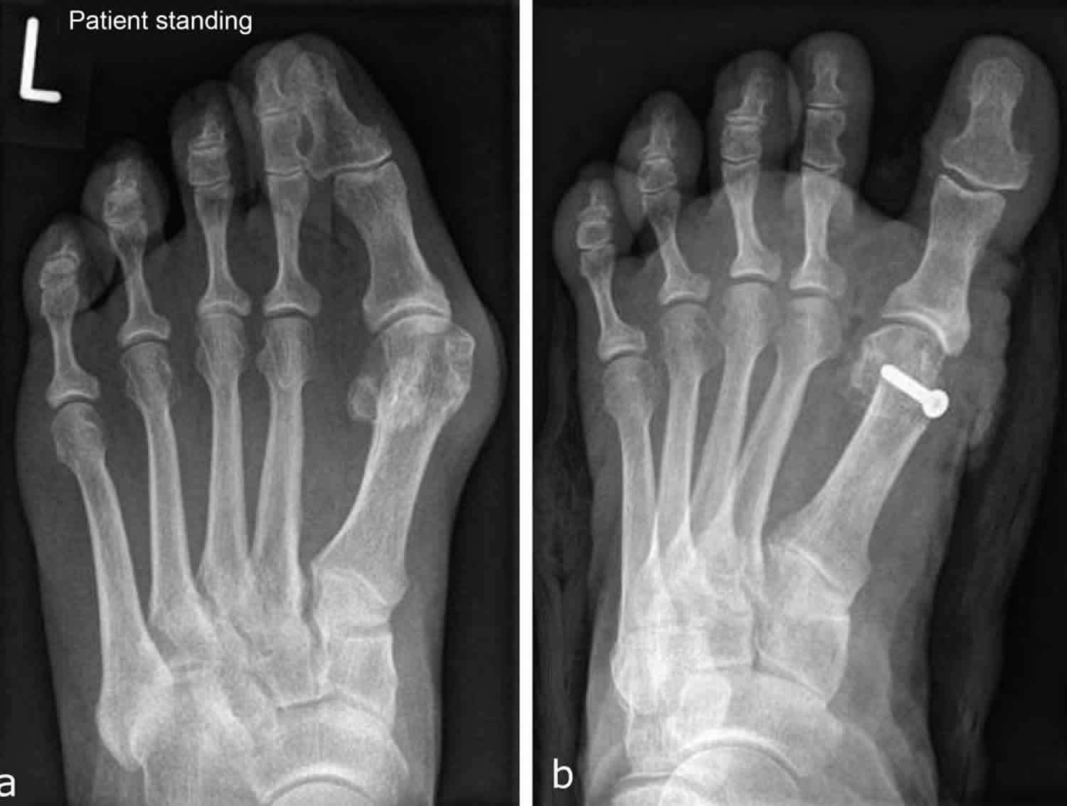 Hallux Valgus Deformity Causes Hallux Valgus Bunion Treatment