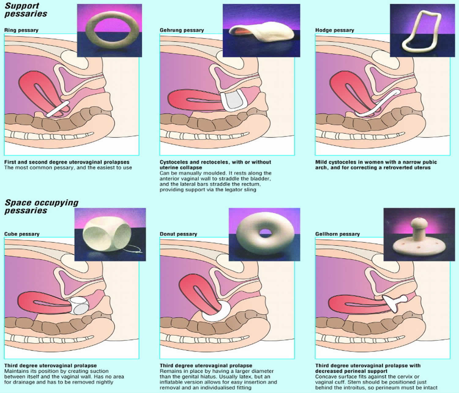 Types of pessaries - Mayo Clinic