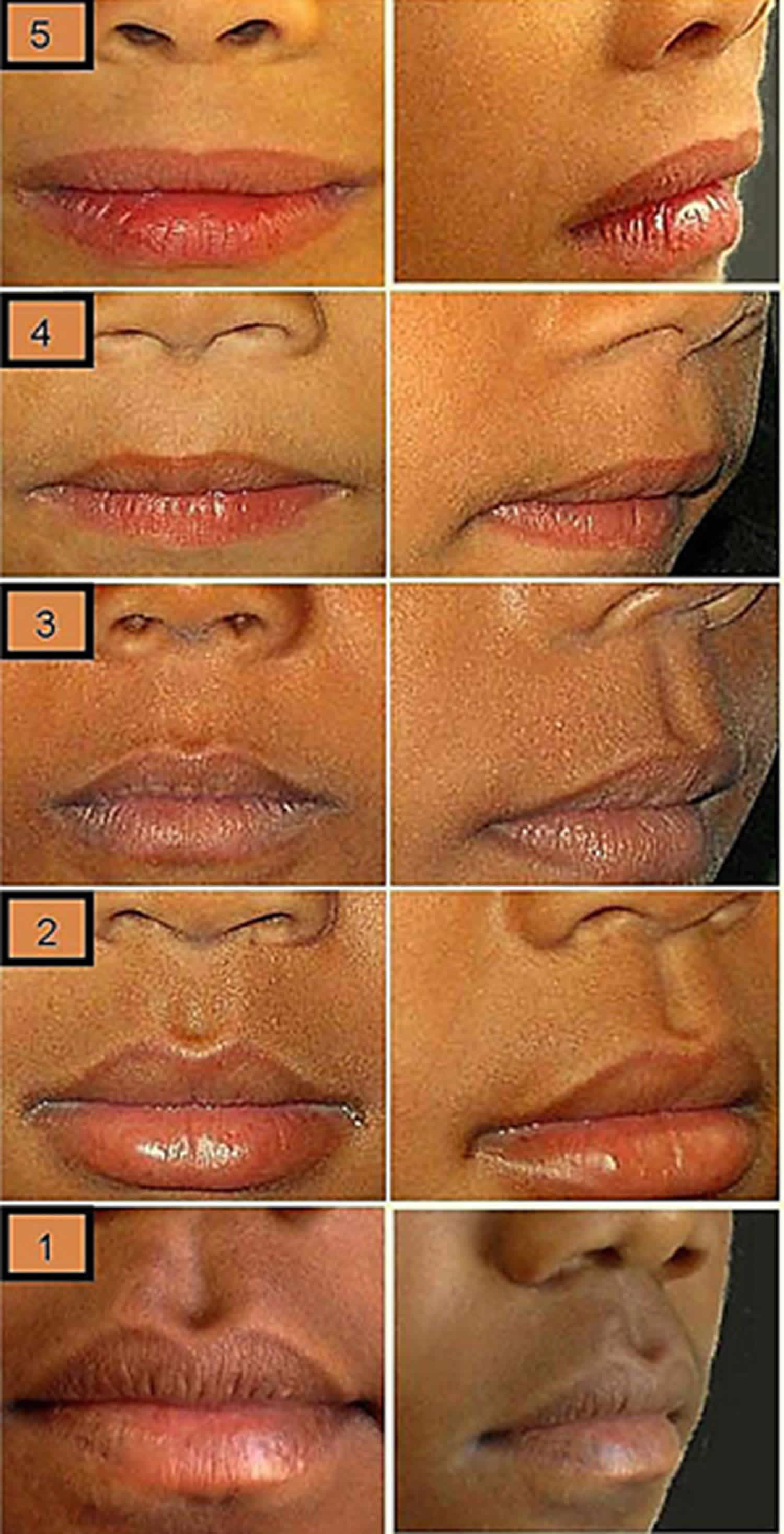 Philtrum of lip, causes of smooth philtrum, long or short philtrum