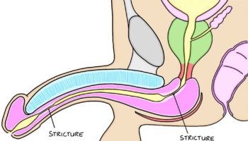 Urethral stricture