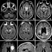 brain lesions