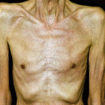 cachexia