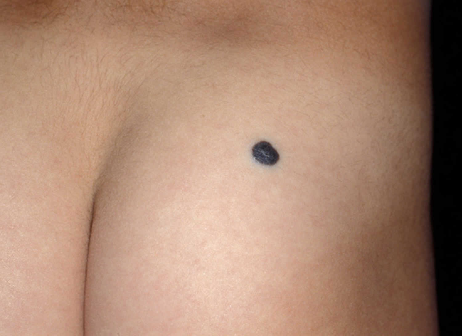 Cellular blue nevus