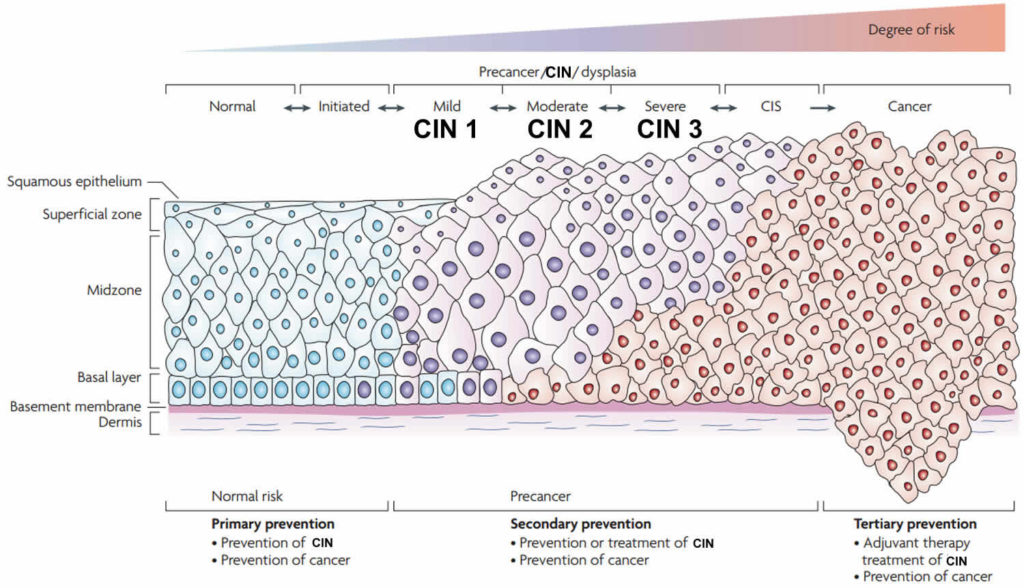 Cervical Intraepithelial Neoplasia Grade 1 2 And 3 Definition And