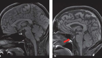 empty sella syndrome