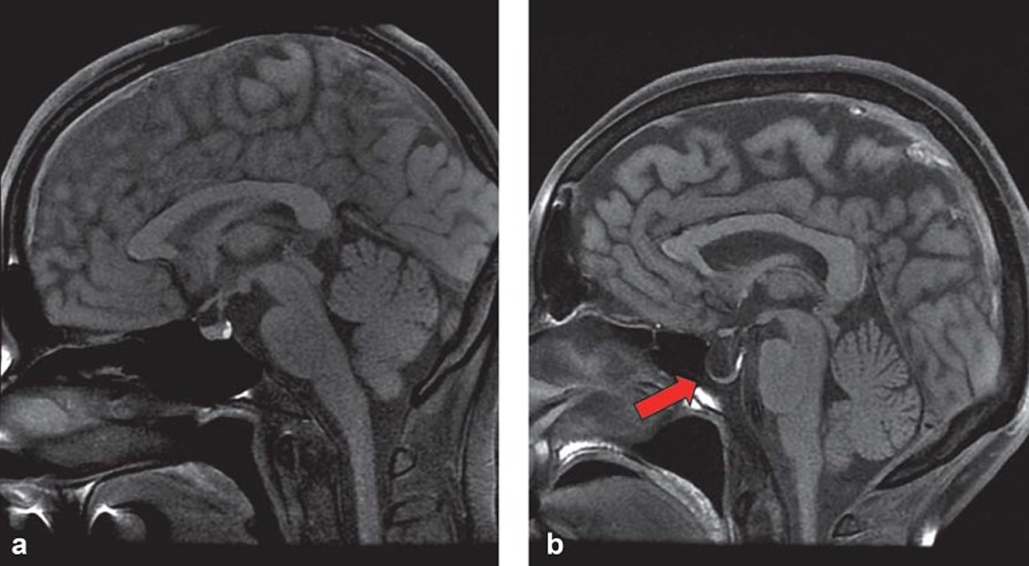 empty-sella-syndrome-causes-risk-factors-symptoms-diagnosis-treatment