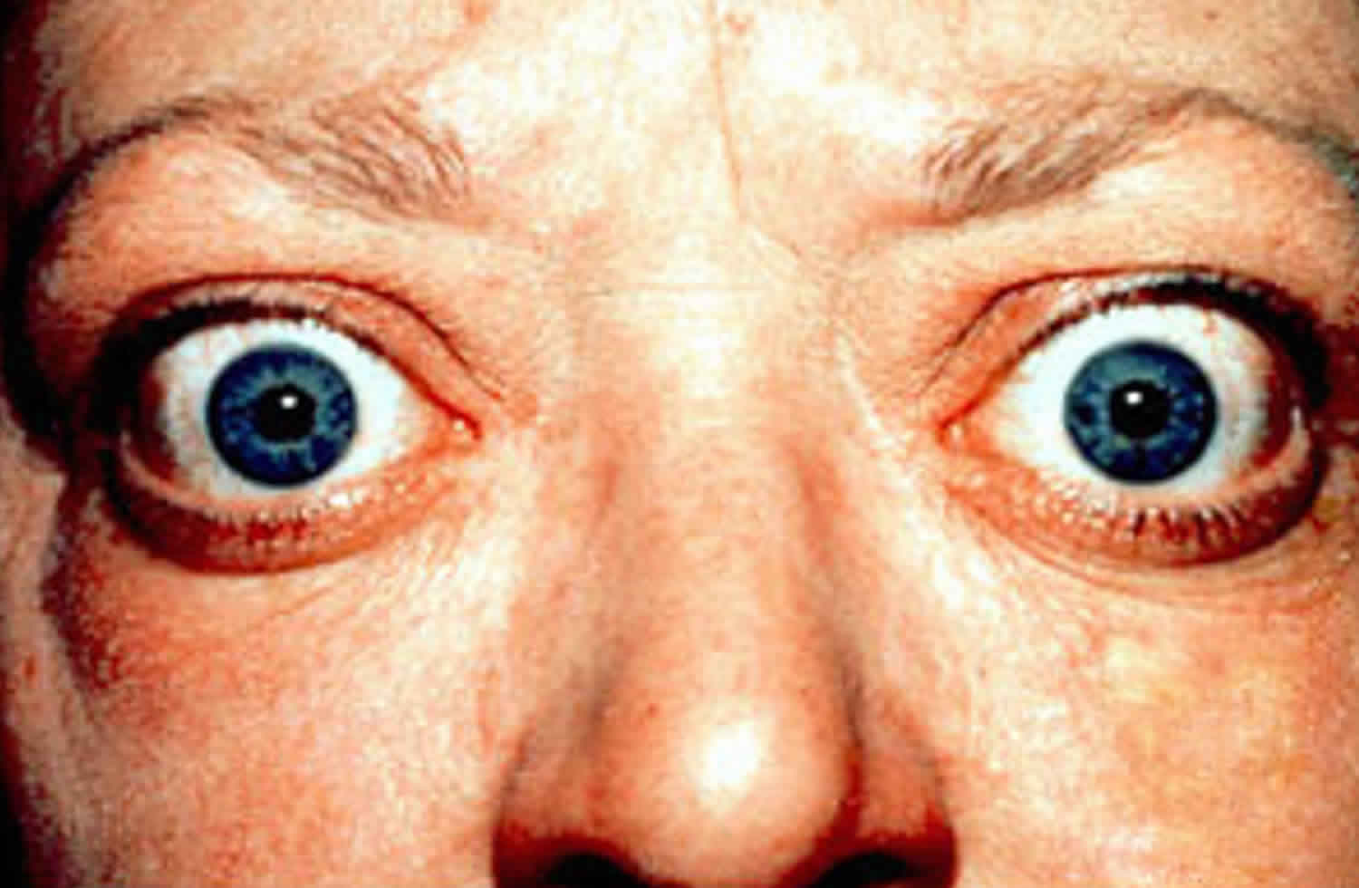 Exophthalmos Proptosis Bulging Eyes Causes Diagnosis Treatment