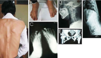 fibrodysplasia ossificans progressiva fop