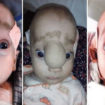 frontal encephalocele