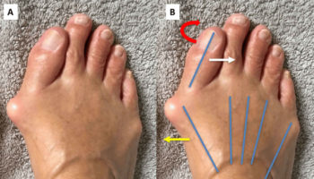 hallux valgus