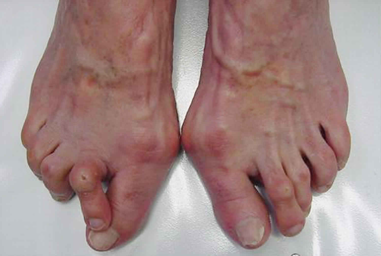 hallux-valgus-deformity-causes-hallux-valgus-bunion-treatment