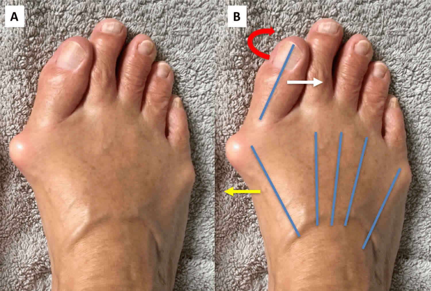 Hallux Valgus Deformity Causes Hallux Valgus Bunion Treatment