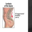 lordosis
