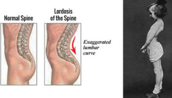 lordosis