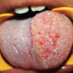 lymphangioma tongue