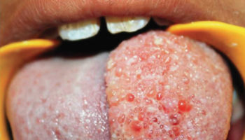 lymphangioma tongue