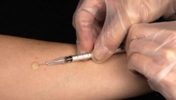 mantoux test