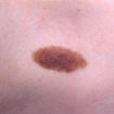 nevus