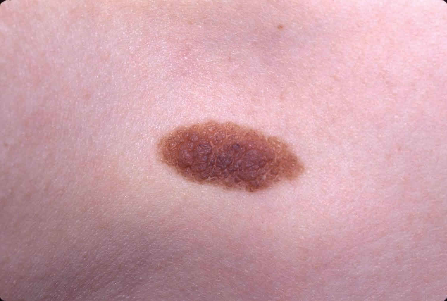 Are Hairy Nevus Hereditary