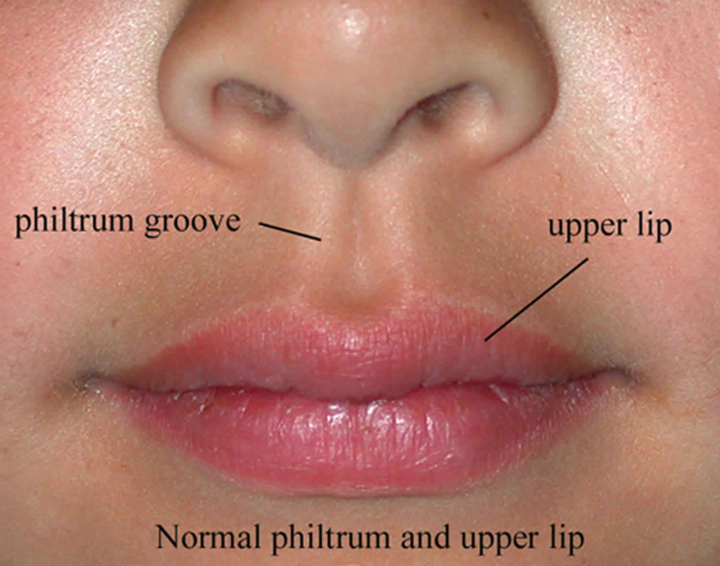 Philtrum of lip, causes of smooth philtrum, long or short philtrum
