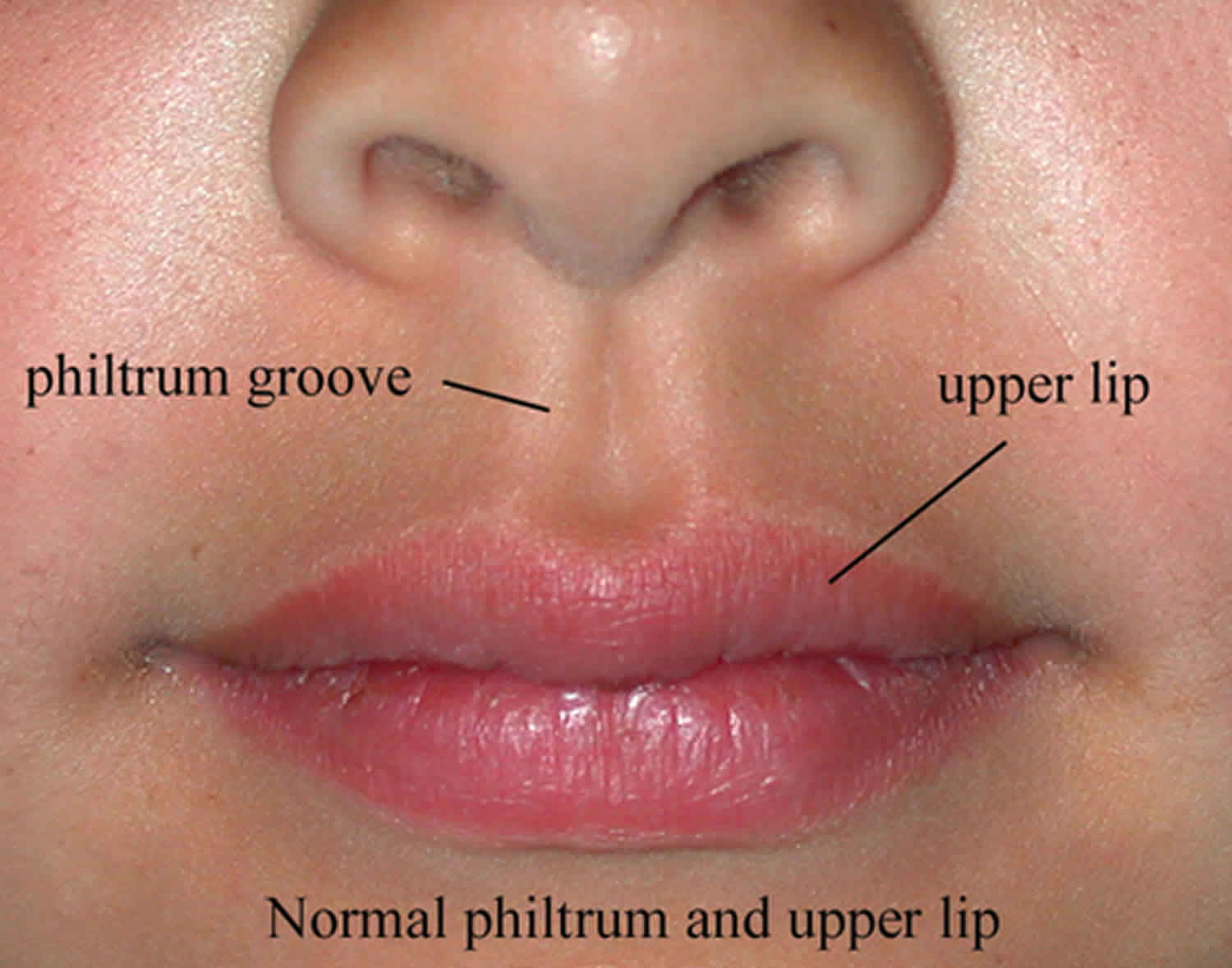 smooth philtrum