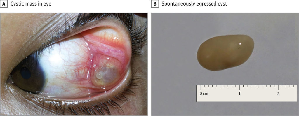 Cysticercosis Causes Prevention Symptoms Diagnosis And Treatment