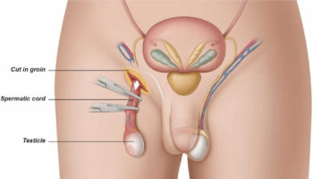 orchiectomy