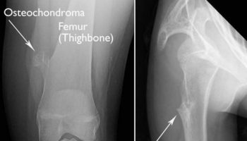 osteochondroma