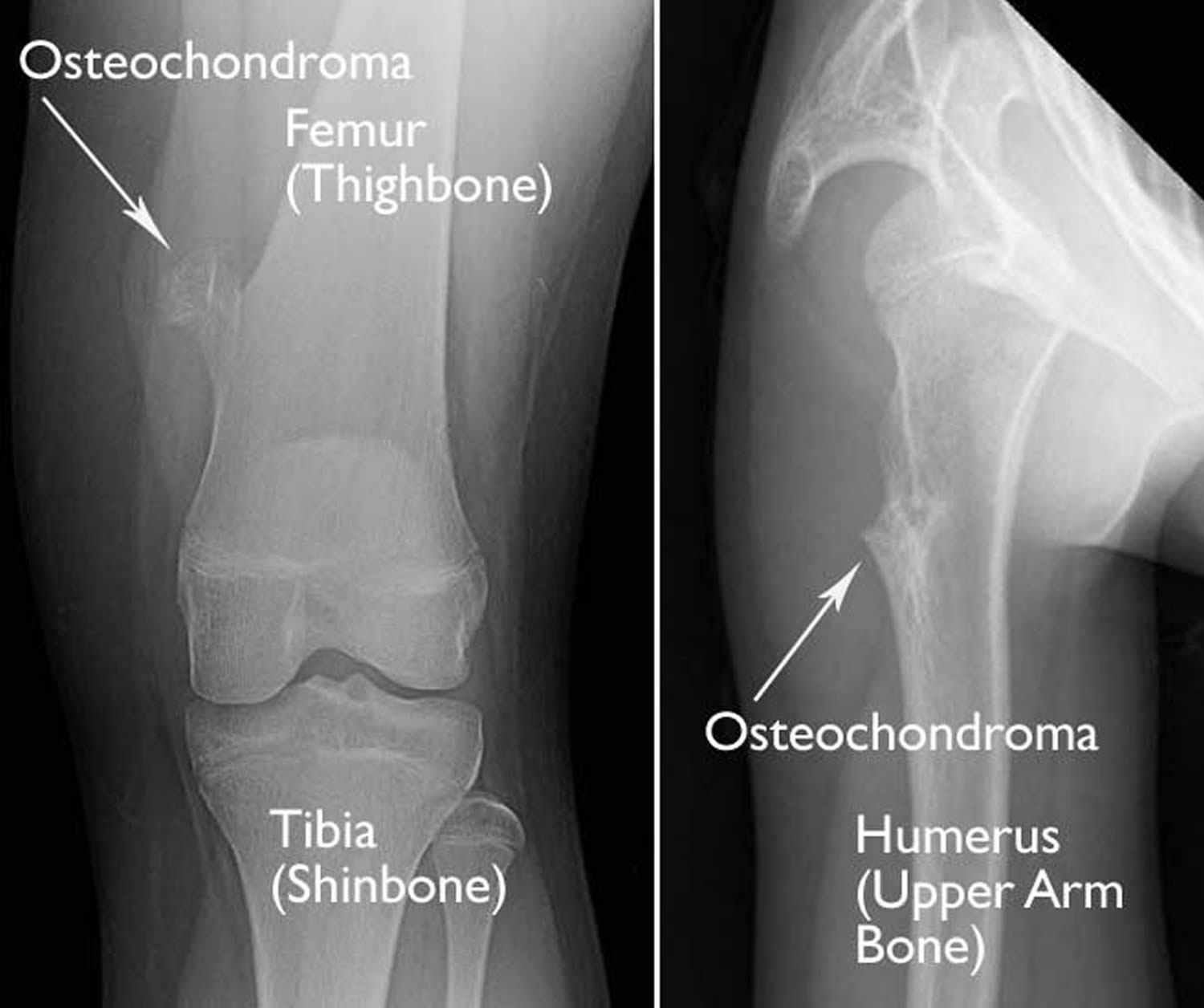 se poate vindeca osteoartrita tratament pentru genunchi