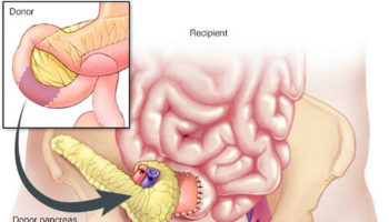 pancreas transplant