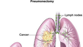 pneumonectomy