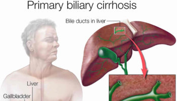 primary biliary cholangitis