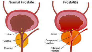 prostatitis