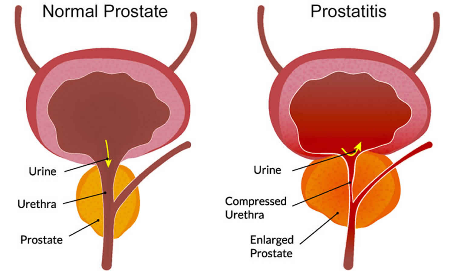 Prostatitis Acute Or Chronic Causes Symptoms Diagnosis And Treatment 