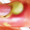 pus