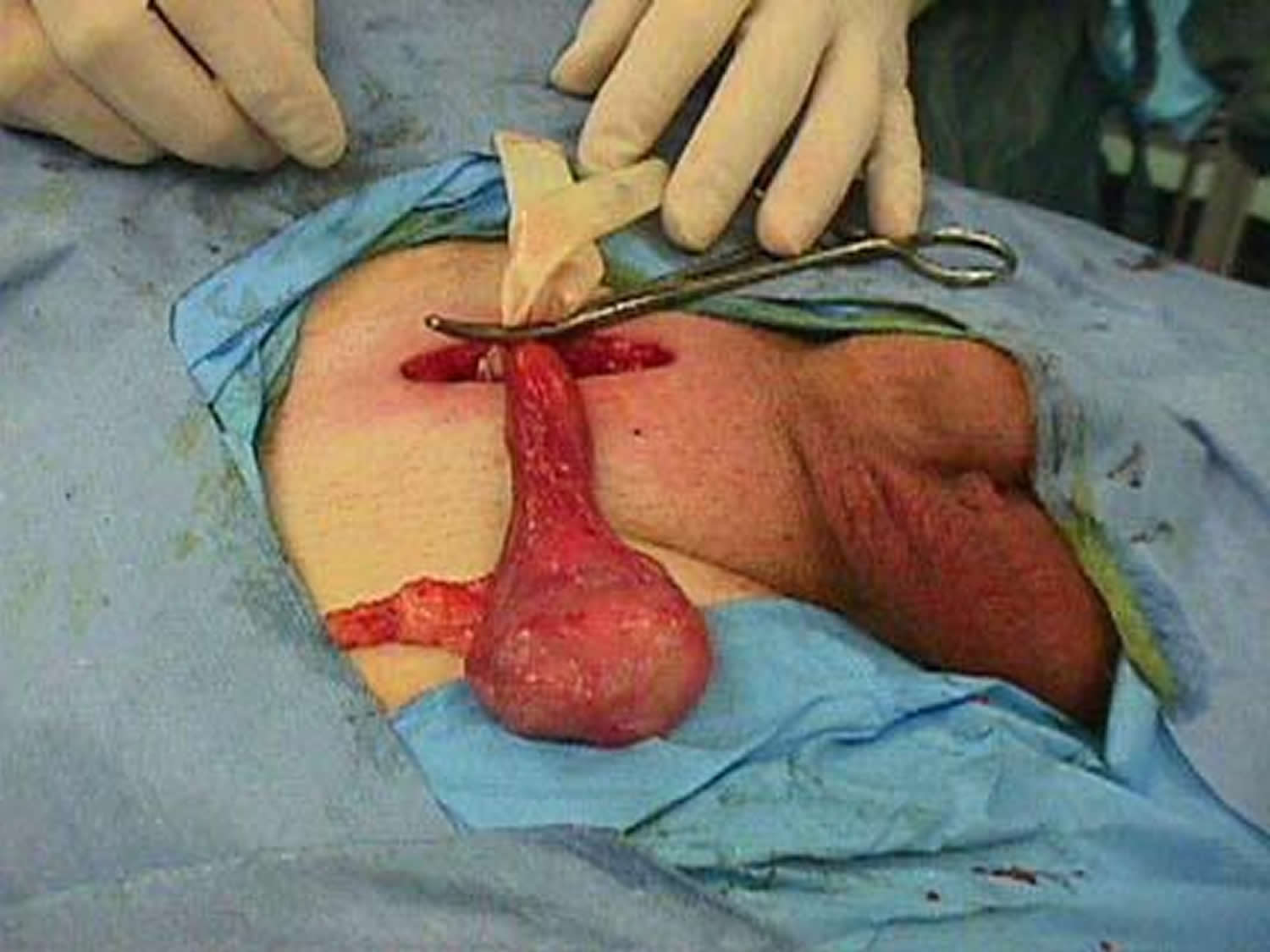 Surgery to remove a testicle with cancer is called a radical inguinal orchi...