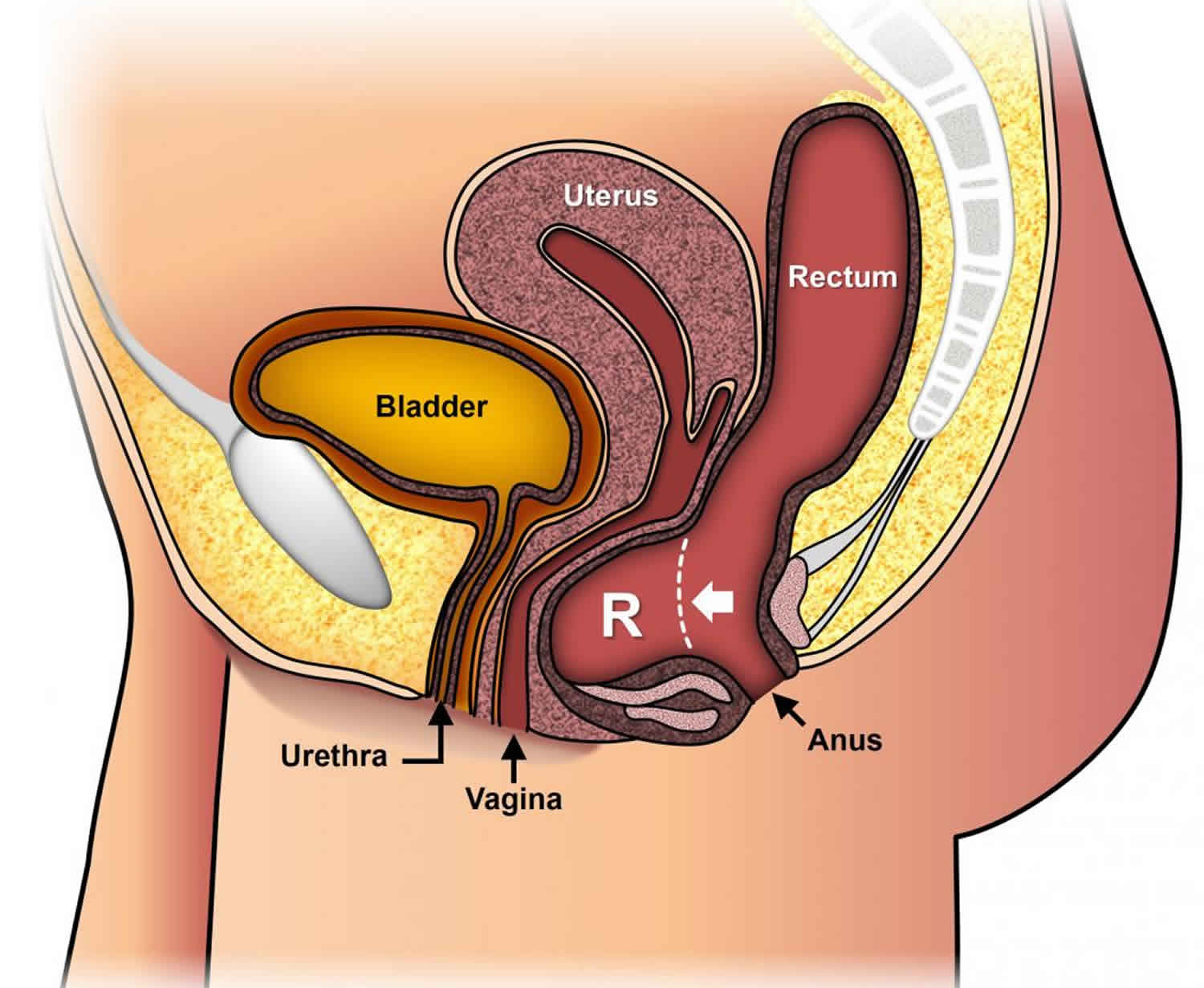 What Is A Synonym For Uterine Prolapse