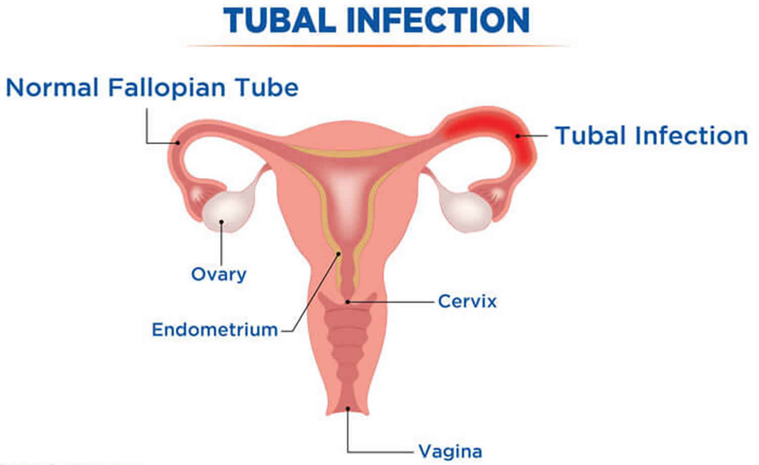 salpingitis-acute-chronic-causes-symptoms-diagnosis-and-treatment