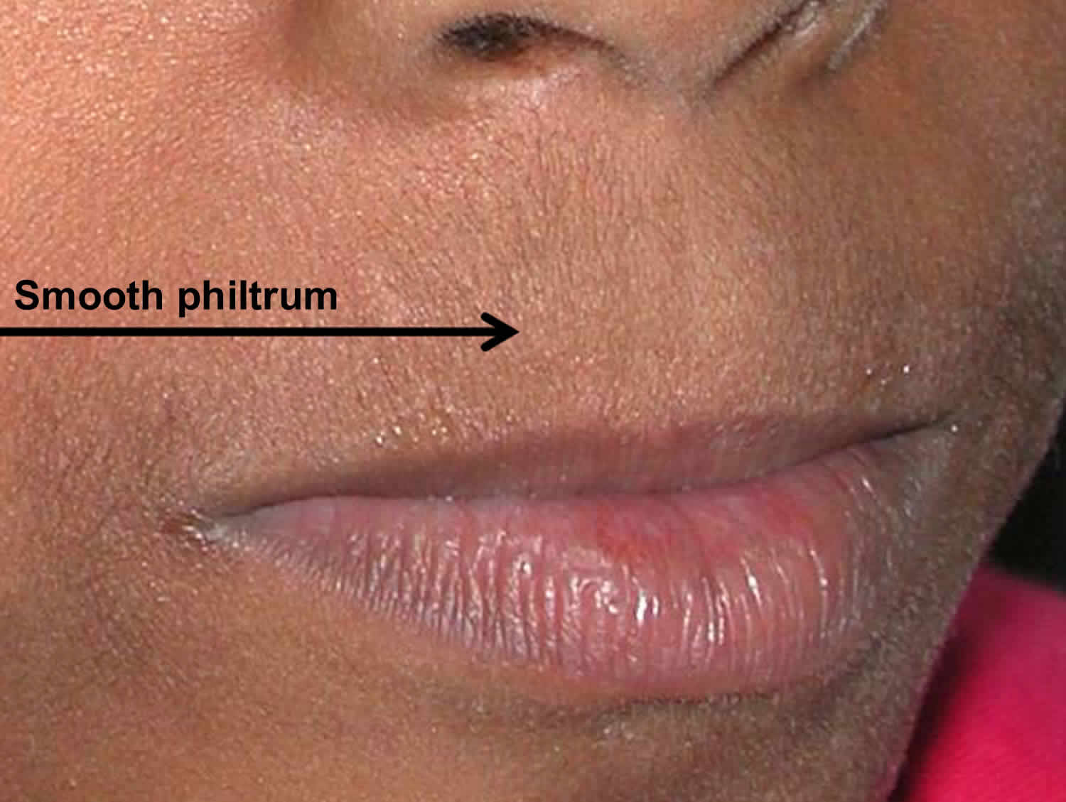 philtrum-of-lip-causes-of-smooth-philtrum-long-or-short-philtrum