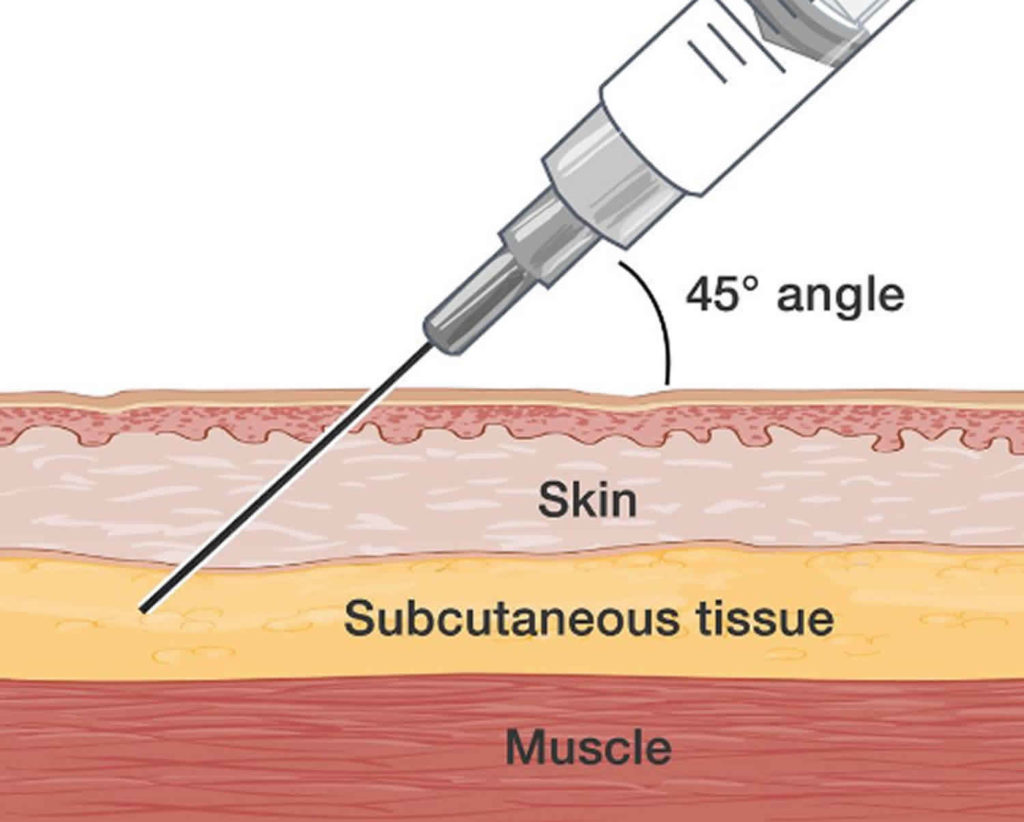 Subcutaneous injection sites, how to give subcutaneous injection