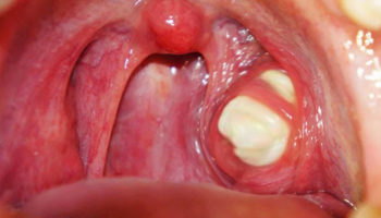 tonsil stones