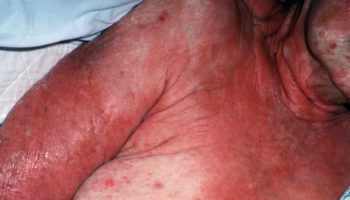 toxic epidermal necrolysis