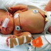 tracheoesophageal fistula in newborn
