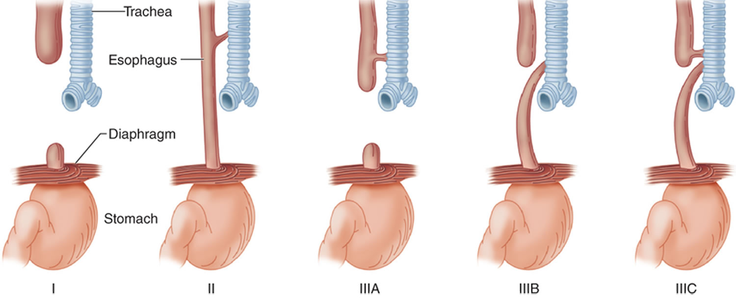 Esophageal Atresia And Or Tracheoesophageal Fistula Obgyn Key Sexiz Pix