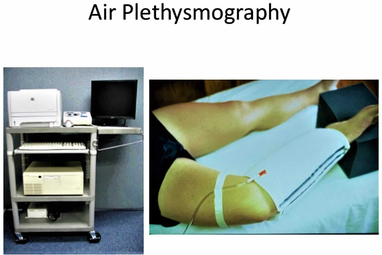 Limb plethysmography