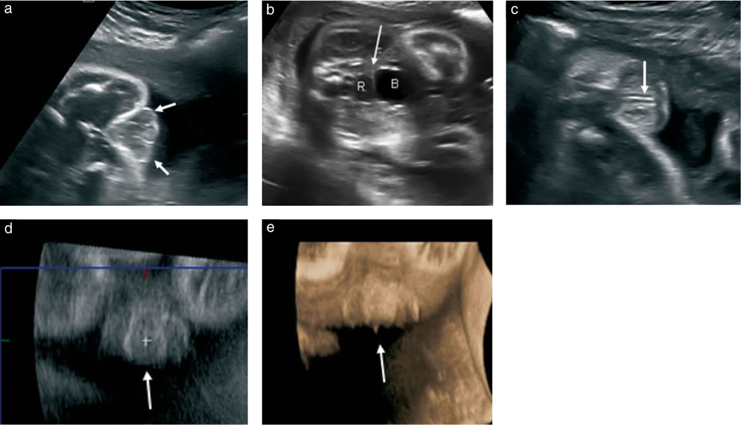 Ambiguous genitalia ultrasound