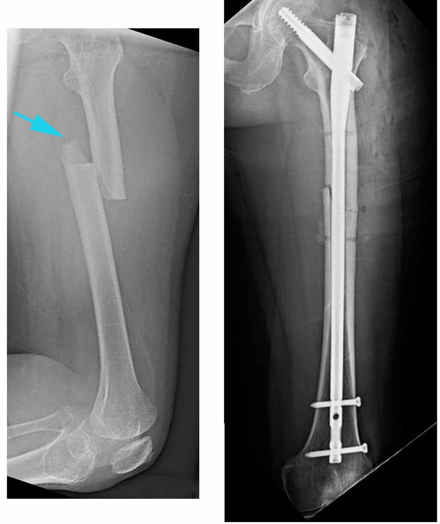 Реабилитация после перелома бедренной кости после операции