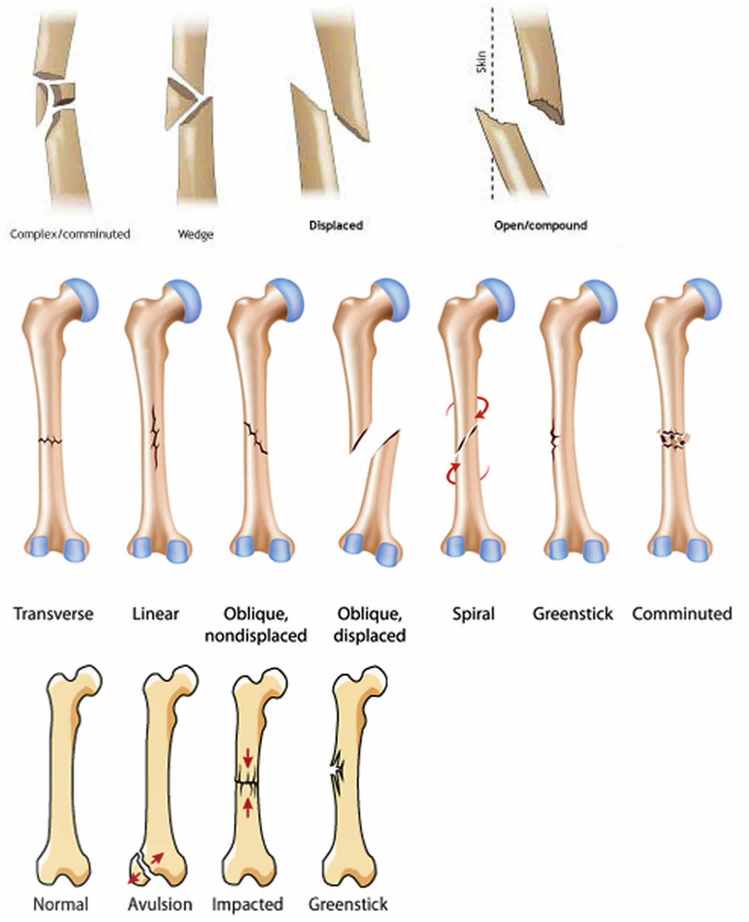 femur break death