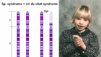 Cri du chat syndrome